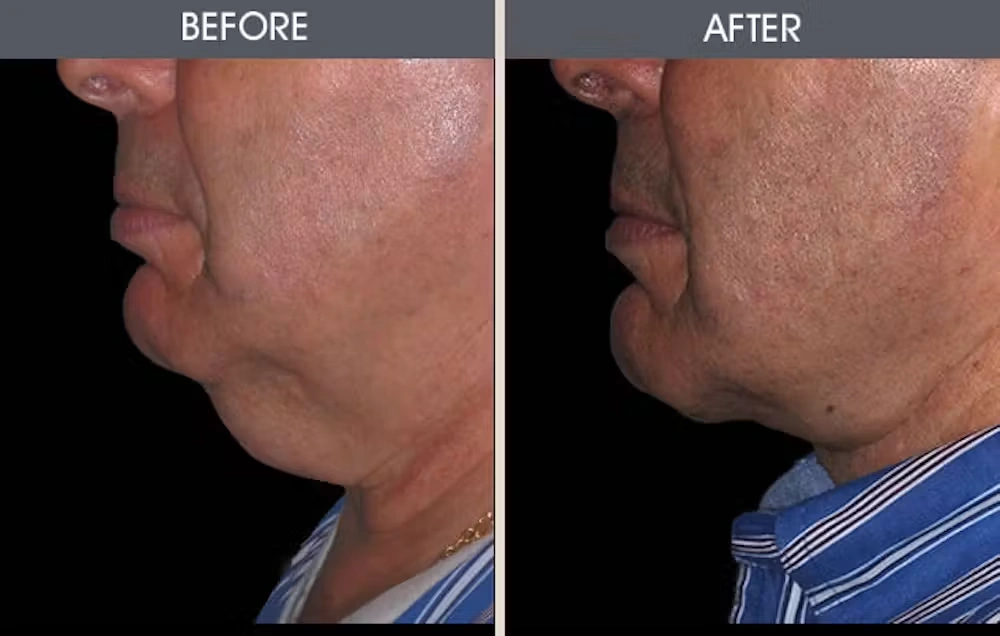 Real patient results in New York, NY Performed by Darrick E. Antell MD, FACS