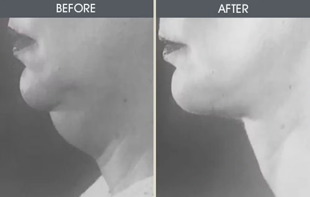 Real patient results in New York, NY Performed by Darrick E. Antell MD, FACS