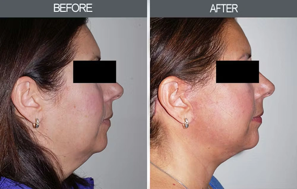 Real patient results in New York, NY Performed by Darrick E. Antell MD, FACS