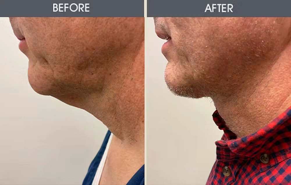 Real patient results in New York, NY Performed by Darrick E. Antell MD, FACS