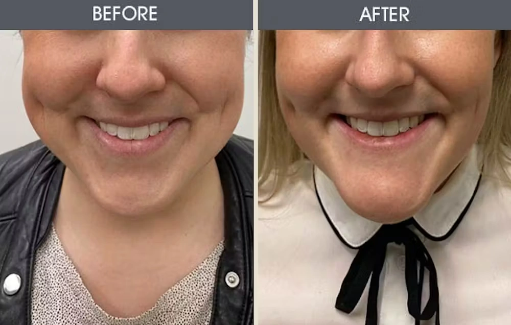 Real patient results in New York, NY Performed by Darrick E. Antell MD, FACS
