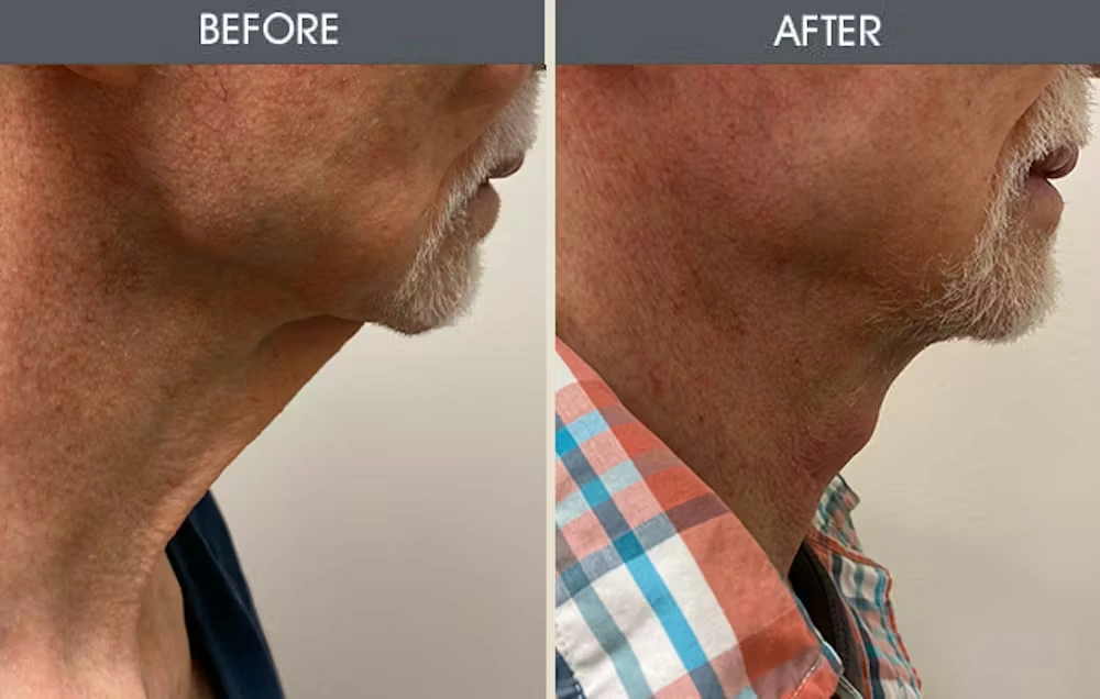 Real patient results in New York, NY Performed by Darrick E. Antell MD, FACS