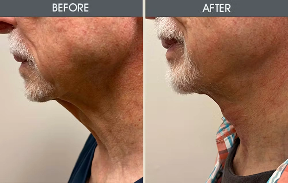 Real patient results in New York, NY Performed by Darrick E. Antell MD, FACS