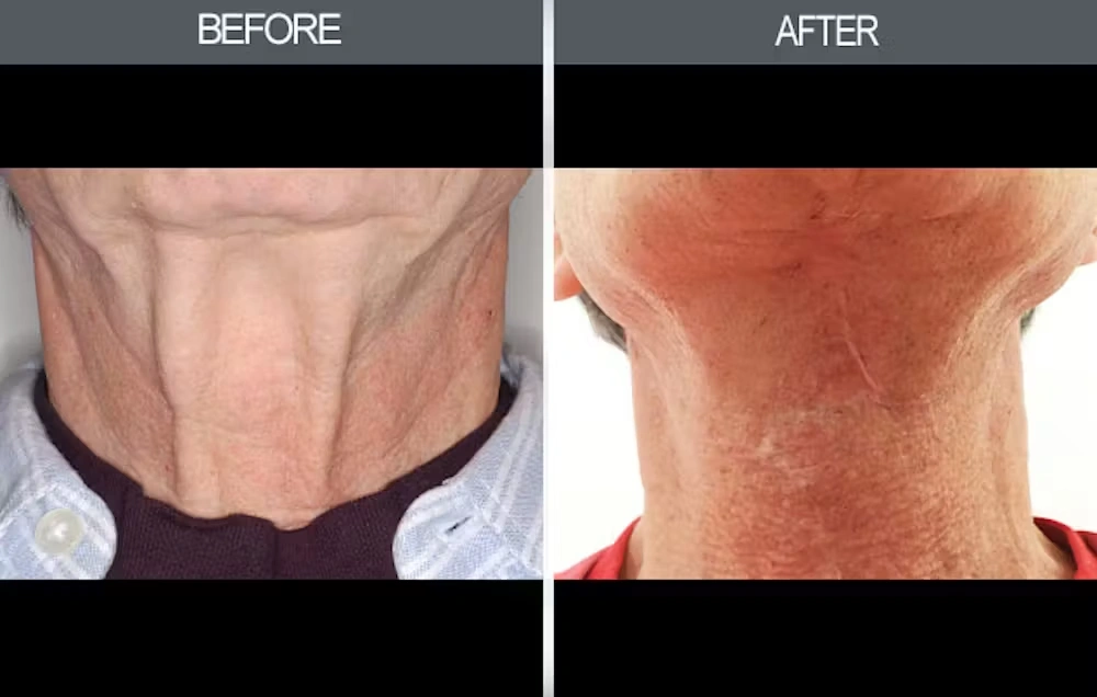 Real patient results in New York, NY Performed by Darrick E. Antell MD, FACS