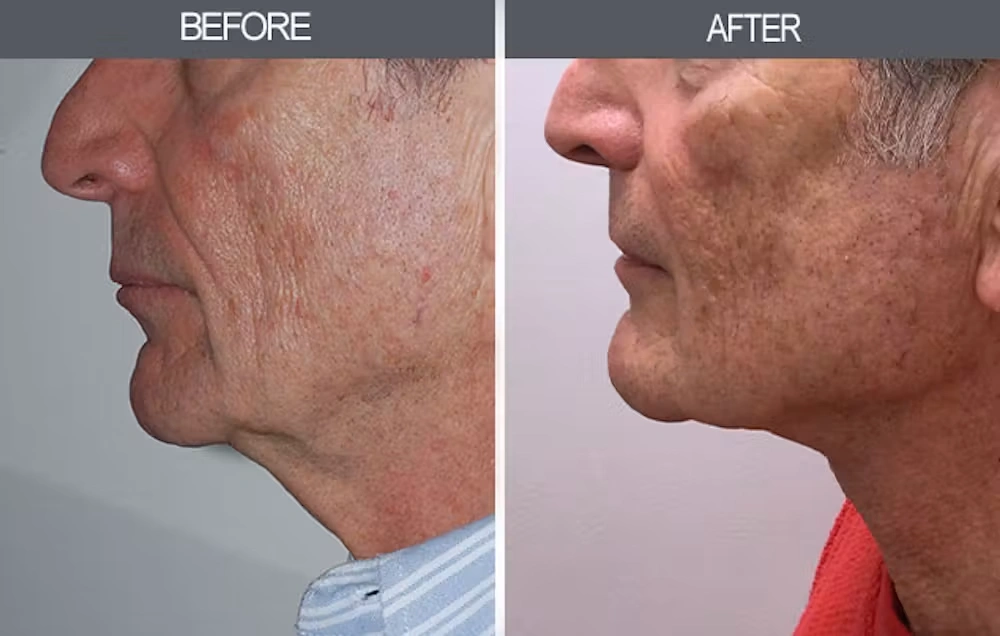 Real patient results in New York, NY Performed by Darrick E. Antell MD, FACS