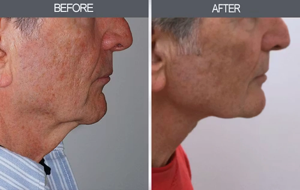 Real patient results in New York, NY Performed by Darrick E. Antell MD, FACS