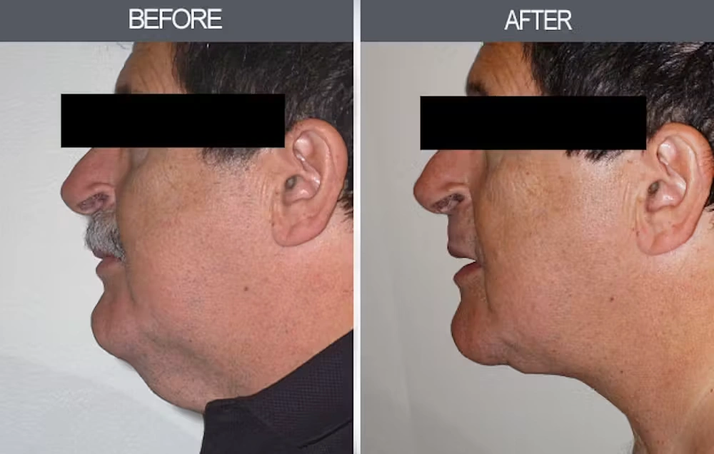 Real patient results in New York, NY Performed by Darrick E. Antell MD, FACS