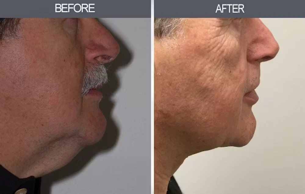 Real patient results in New York, NY Performed by Darrick E. Antell MD, FACS