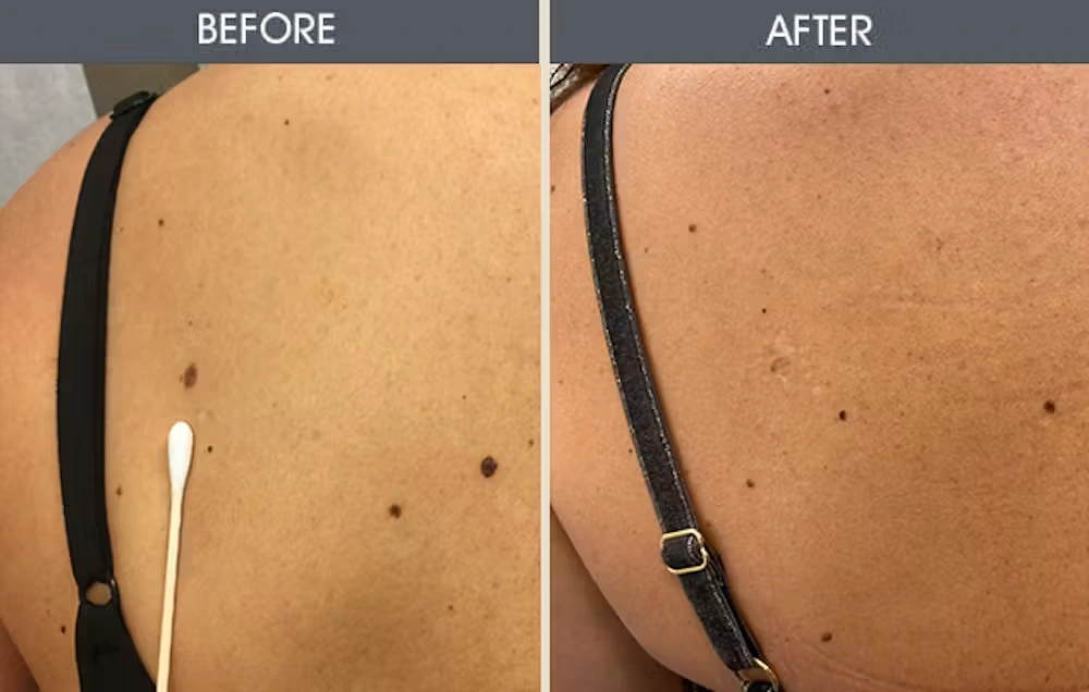 Real patient results in New York, NY Performed by Darrick E. Antell MD, FACS