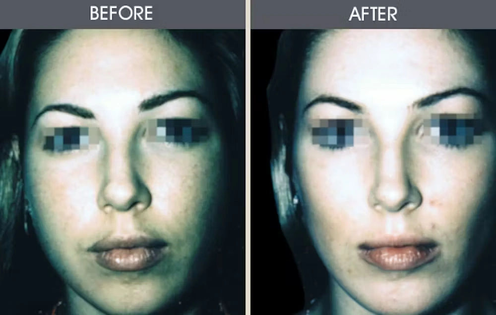 Real patient results in New York, NY Performed by Darrick E. Antell MD, FACS