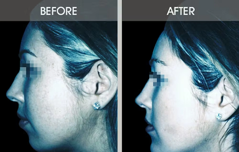 Real patient results in New York, NY Performed by Darrick E. Antell MD, FACS
