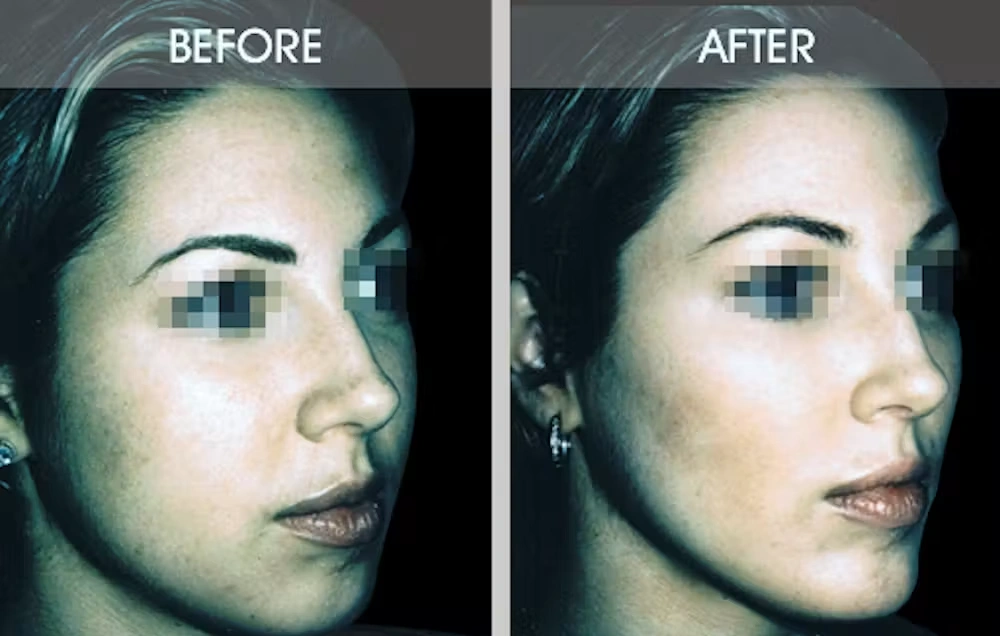 Real patient results in New York, NY Performed by Darrick E. Antell MD, FACS