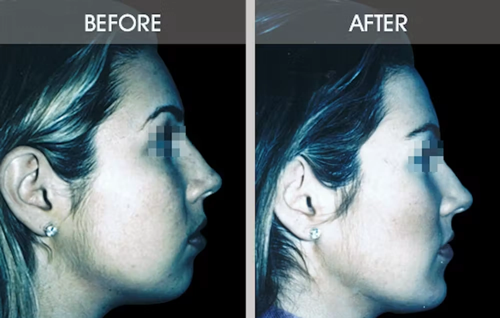 Real patient results in New York, NY Performed by Darrick E. Antell MD, FACS