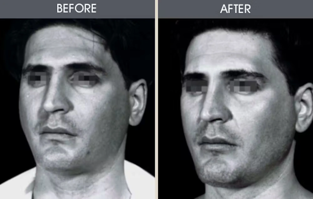 Real patient results in New York, NY Performed by Darrick E. Antell MD, FACS