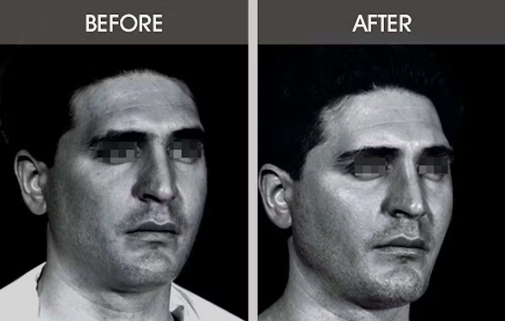 Real patient results in New York, NY Performed by Darrick E. Antell MD, FACS