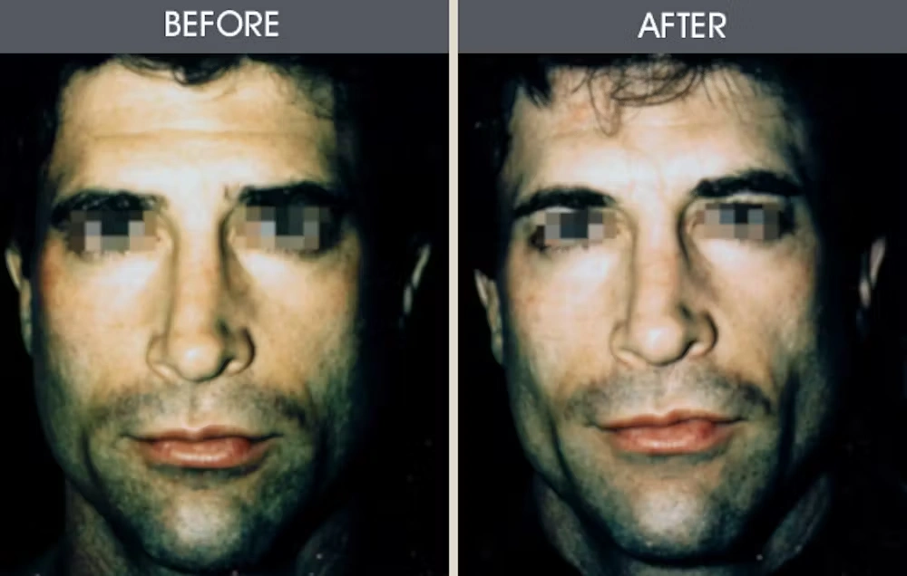 Real patient results in New York, NY Performed by Darrick E. Antell MD, FACS