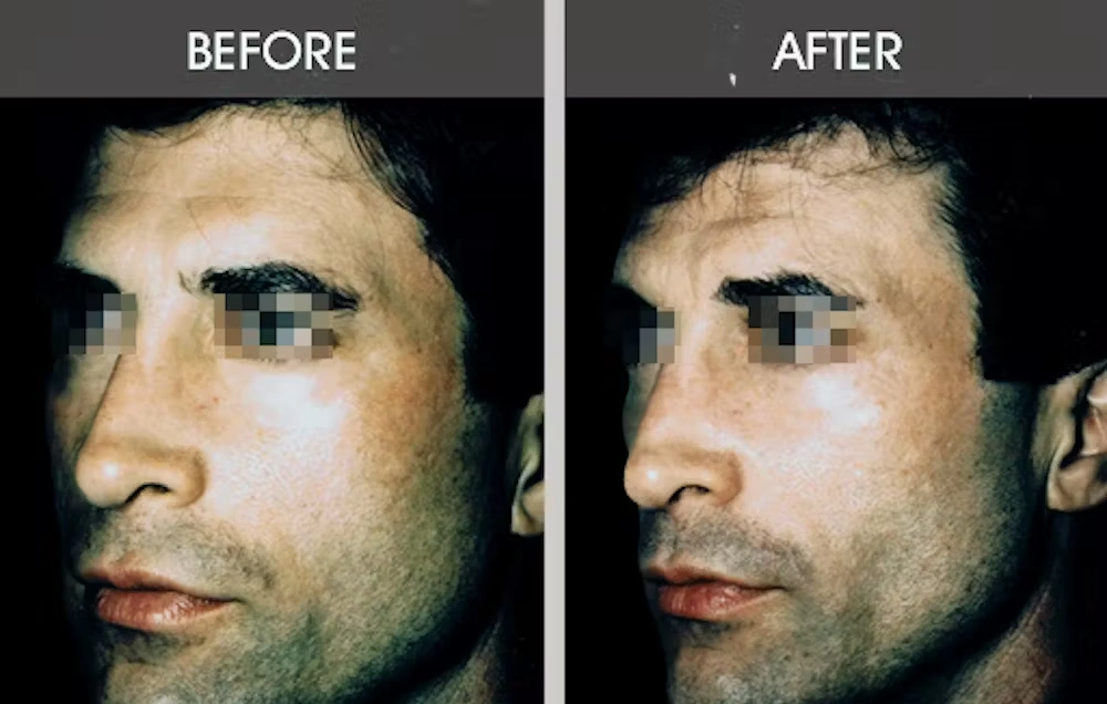 Real patient results in New York, NY Performed by Darrick E. Antell MD, FACS