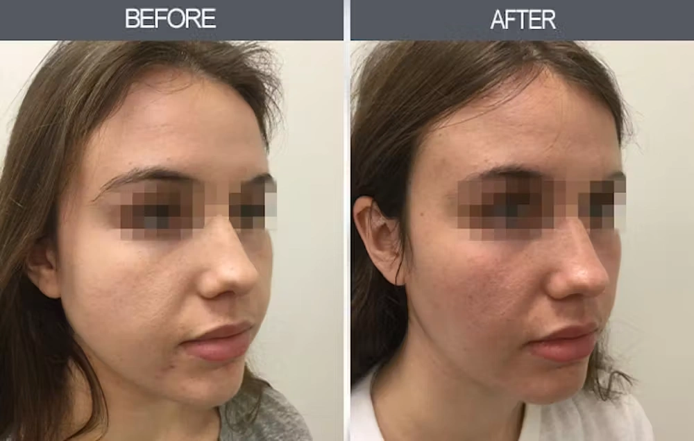 Real patient results in New York, NY Performed by Darrick E. Antell MD, FACS