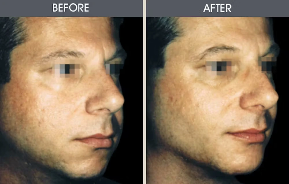 Real patient results in New York, NY Performed by Darrick E. Antell MD, FACS