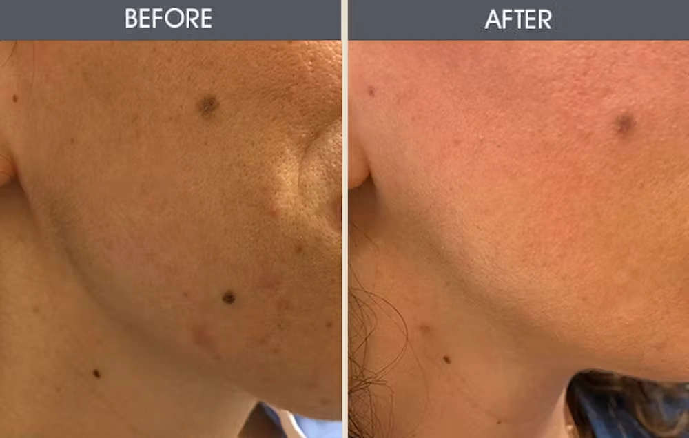 Real patient results in New York, NY Performed by Darrick E. Antell MD, FACS