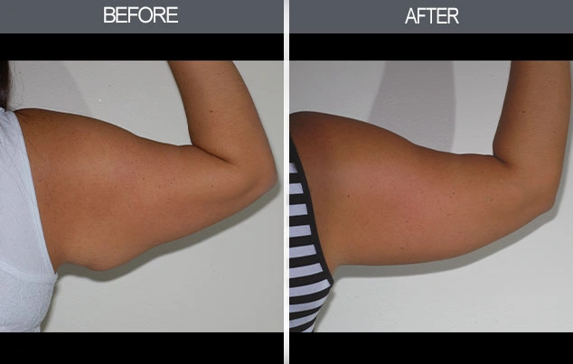 Real patient results in New York, NY Performed by Darrick E. Antell MD, FACS