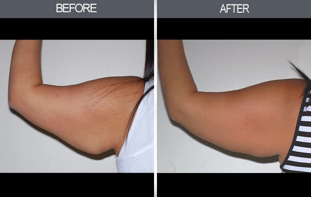 Real patient results in New York, NY Performed by Darrick E. Antell MD, FACS