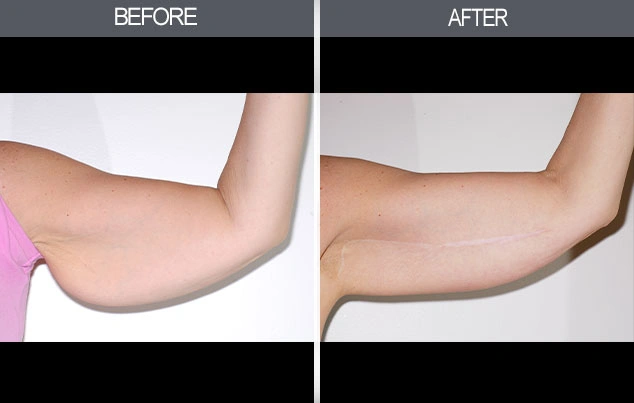 Real patient results in New York, NY Performed by Darrick E. Antell MD, FACS