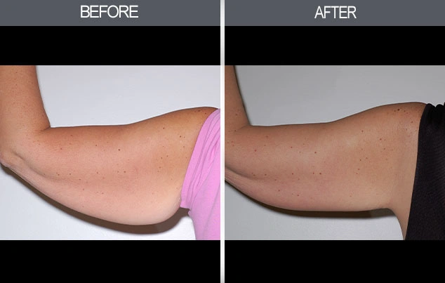 Real patient results in New York, NY Performed by Darrick E. Antell MD, FACS