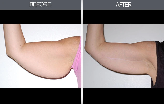 Real patient results in New York, NY Performed by Darrick E. Antell MD, FACS
