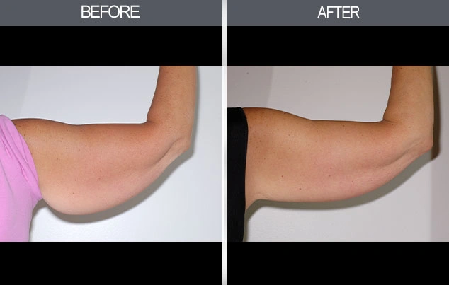 Real patient results in New York, NY Performed by Darrick E. Antell MD, FACS