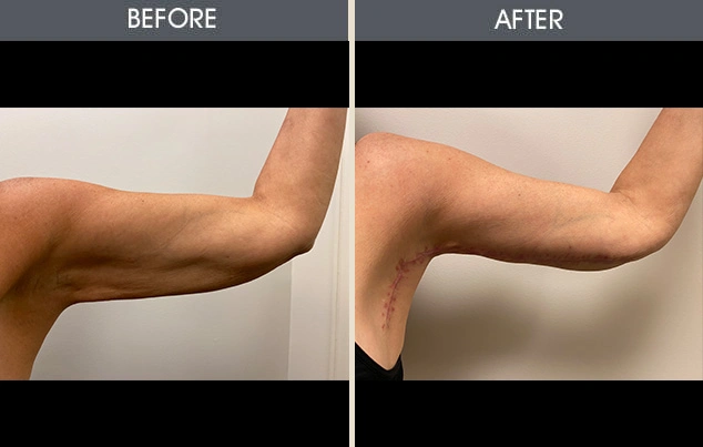 Real patient results in New York, NY Performed by Darrick E. Antell MD, FACS