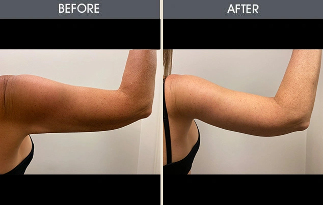 Real patient results in New York, NY Performed by Darrick E. Antell MD, FACS
