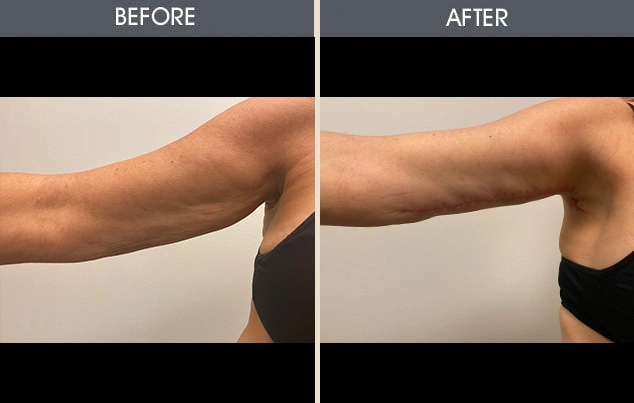 Real patient results in New York, NY Performed by Darrick E. Antell MD, FACS