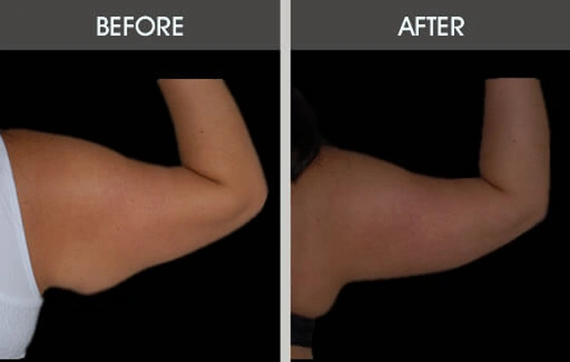 Real patient results in New York, NY Performed by Darrick E. Antell MD, FACS