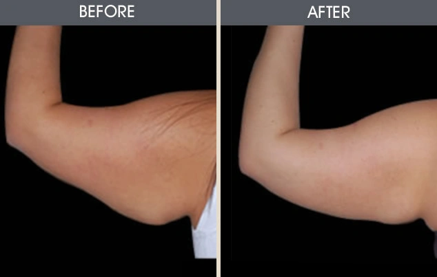 Real patient results in New York, NY Performed by Darrick E. Antell MD, FACS