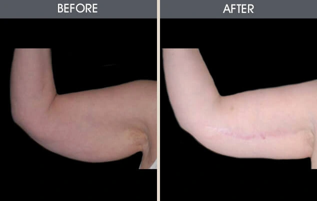 Real patient results in New York, NY Performed by Darrick E. Antell MD, FACS