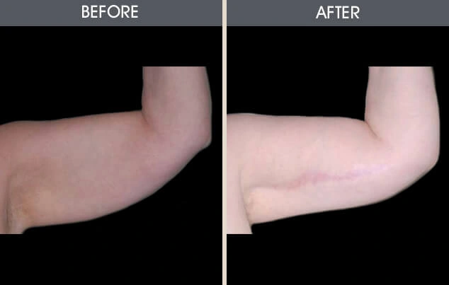 Real patient results in New York, NY Performed by Darrick E. Antell MD, FACS