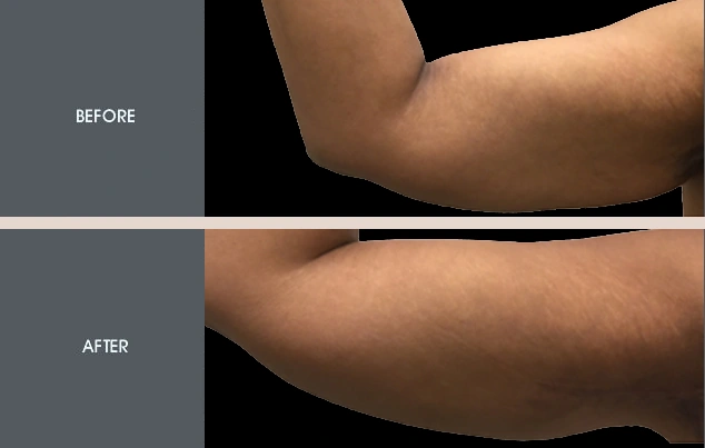 Real patient results in New York, NY Performed by Darrick E. Antell MD, FACS