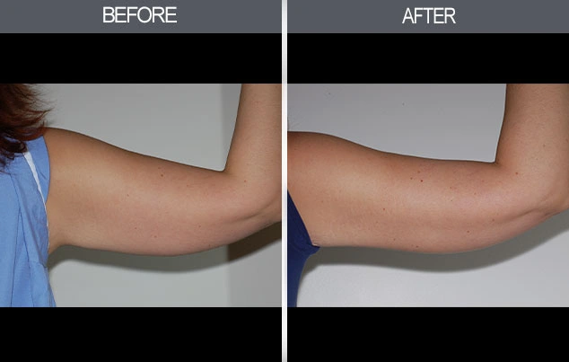 Real patient results in New York, NY Performed by Darrick E. Antell MD, FACS