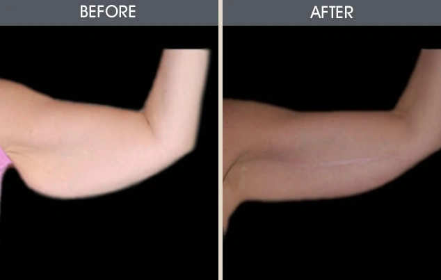 Real patient results in New York, NY Performed by Darrick E. Antell MD, FACS