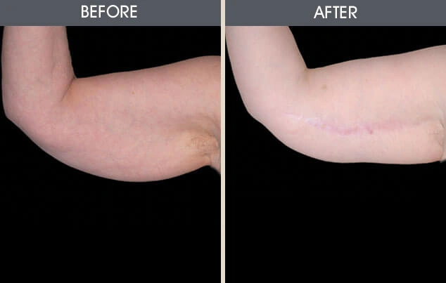 Real patient results in New York, NY Performed by Darrick E. Antell MD, FACS
