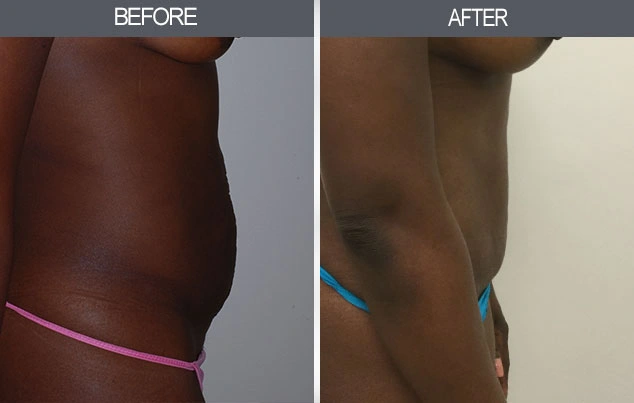 Real patient results in New York, NY Performed by Darrick E. Antell MD, FACS