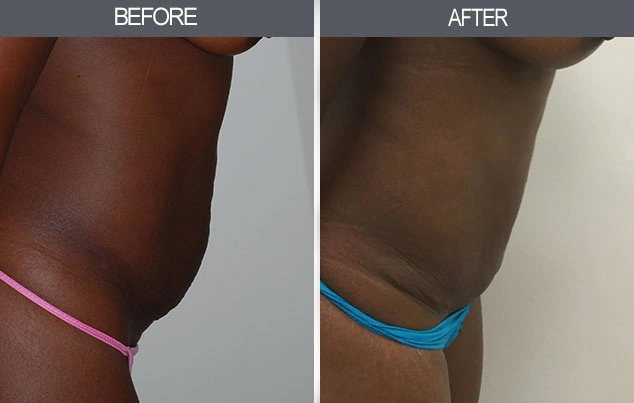Real patient results in New York, NY Performed by Darrick E. Antell MD, FACS