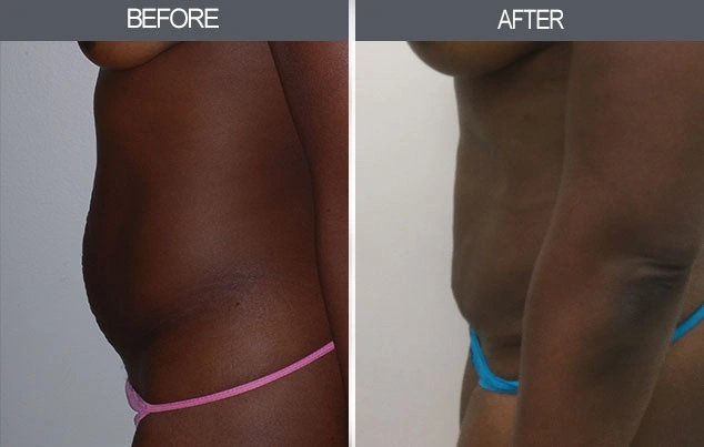 Real patient results in New York, NY Performed by Darrick E. Antell MD, FACS